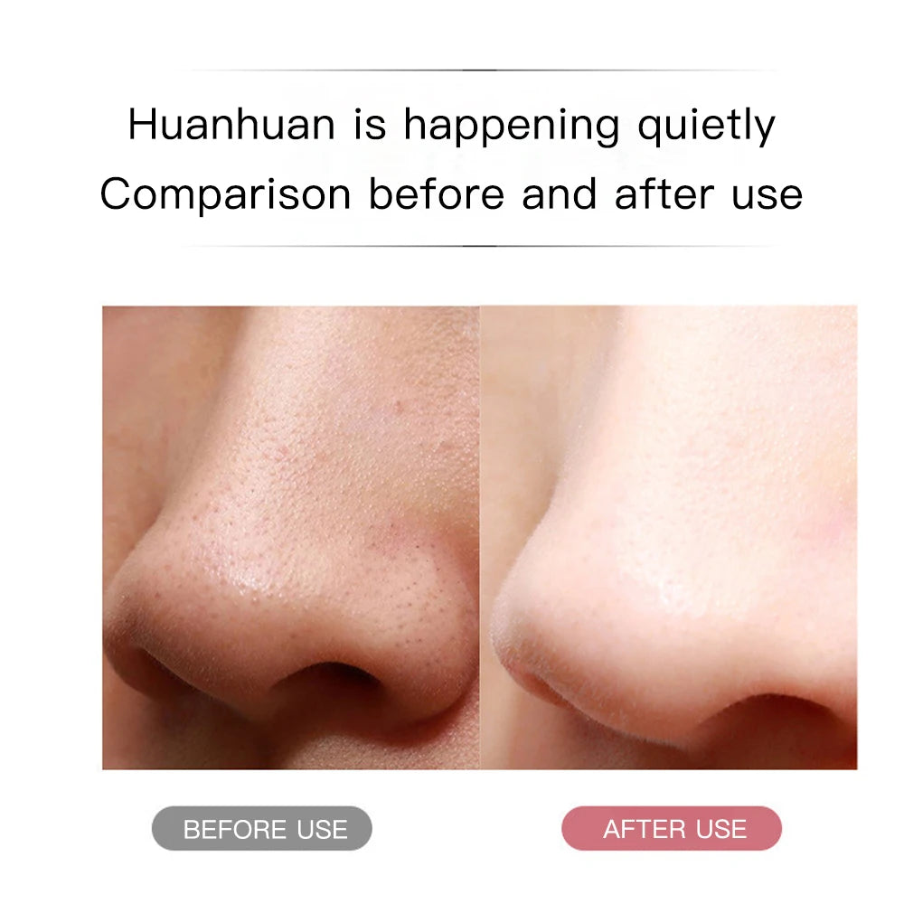 LumiSkin Ultrasonic Facial Scrubber – Deep Cleansing, Blackhead Remover & Skin Lifting Tool